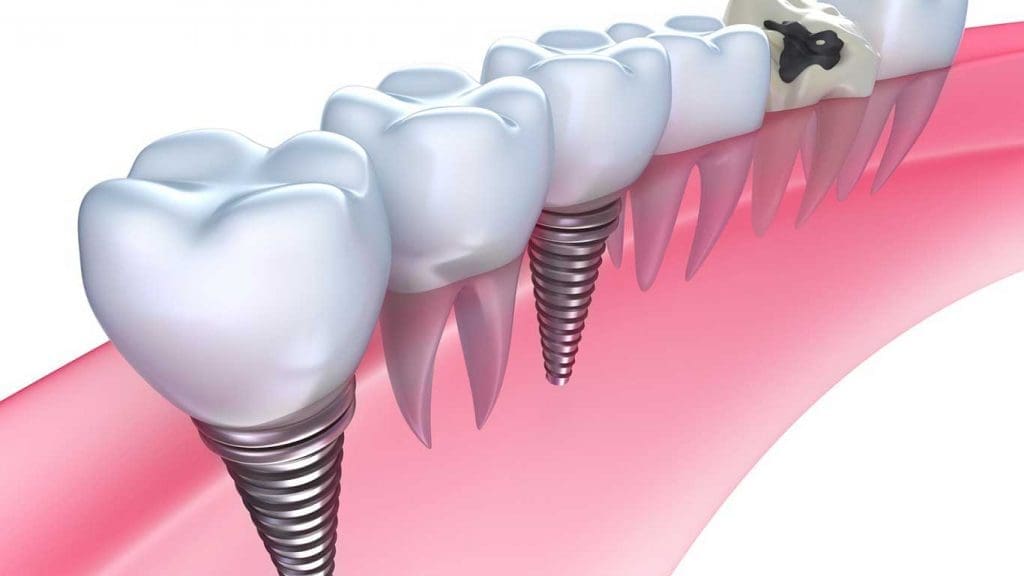 Turlock Dental Implants