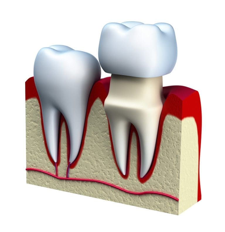 dental crowns