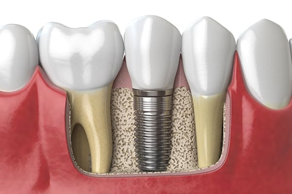 dental-implants